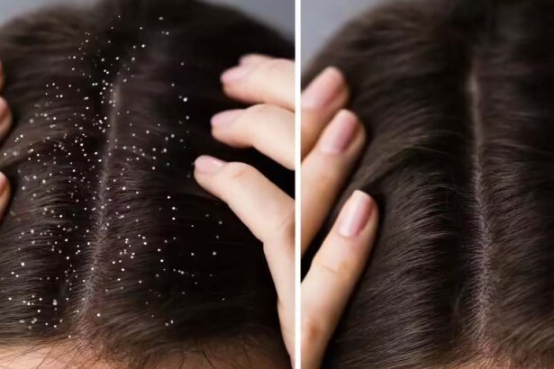 Dandruff