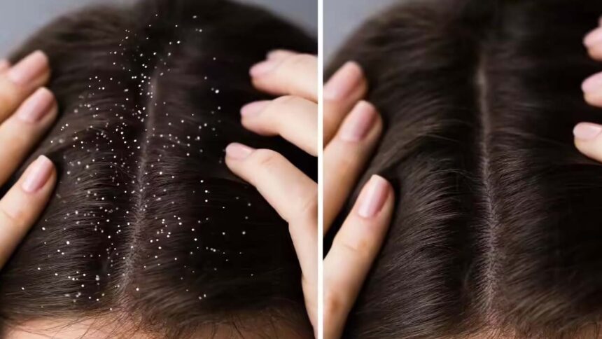 Dandruff