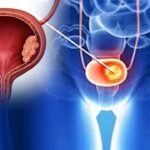 Bladder Cancer Symptoms | మూత్రంలో రక్తం కనిపిస్తోందా.. నిర్లక్ష్యం చేస్తే ఇక అంతే!