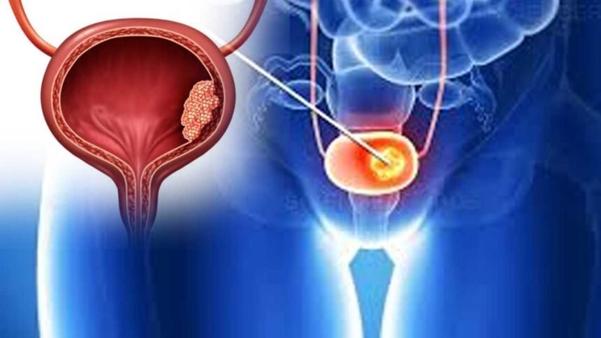 Bladder Cancer Symptoms | మూత్రంలో రక్తం కనిపిస్తోందా.. నిర్లక్ష్యం చేస్తే ఇక అంతే!
