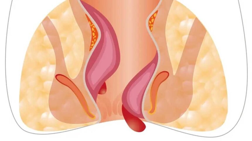 Piles Treatment Tips | పైల్స్ వేధిస్తున్నాయా.. ఆపరేషన్ లేకుండా తగ్గించుకోండిలా!