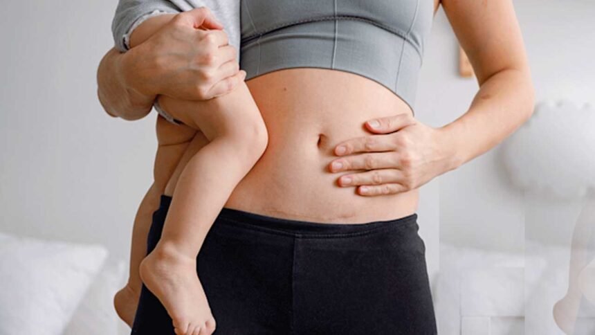 Cesarean Recovery Tips | సిజేరియన్ తర్వాత వచ్చే నీరసం, నొప్పులు.. ఈ సింపుల్ టిప్స్‌తో చెక్ పెట్టండి!