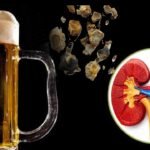Kidney Stones Beer Myth