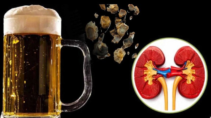 Kidney Stones Beer Myth