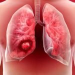 Lung Cancer 