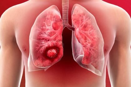 Lung Cancer 