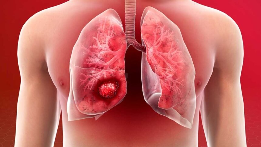 Lung Cancer 