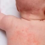 Summer Heat Rash | వేసవిలో వేధించే చెమటకాయ.. ఇలా చేస్తే ఇట్టే మాయం!