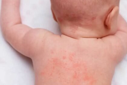 Summer Heat Rash | వేసవిలో వేధించే చెమటకాయ.. ఇలా చేస్తే ఇట్టే మాయం!