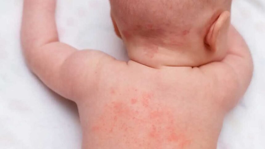 Summer Heat Rash | వేసవిలో వేధించే చెమటకాయ.. ఇలా చేస్తే ఇట్టే మాయం!
