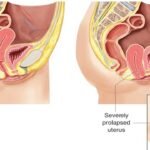 Uterine Prolapse | గర్భసంచి జారిందా.. ఈ లక్షణాలను నిర్లక్ష్యం చేయొద్దు!