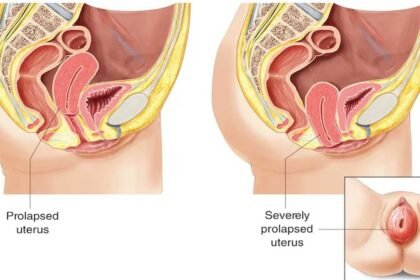 Uterine Prolapse | గర్భసంచి జారిందా.. ఈ లక్షణాలను నిర్లక్ష్యం చేయొద్దు!