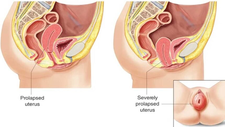 Uterine Prolapse | గర్భసంచి జారిందా.. ఈ లక్షణాలను నిర్లక్ష్యం చేయొద్దు!